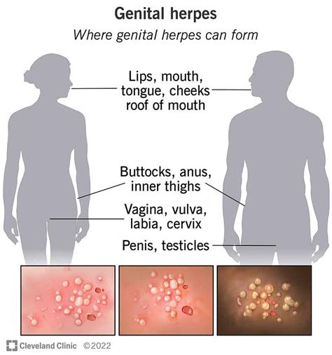 Genital Herpes: Symptoms, Treatment, and Management Guide